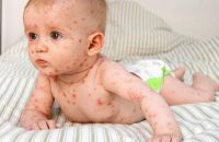 BÀI TUYÊN TRUYỀN PHÒNG CHỐNG DỊCH BỆNH SỞI